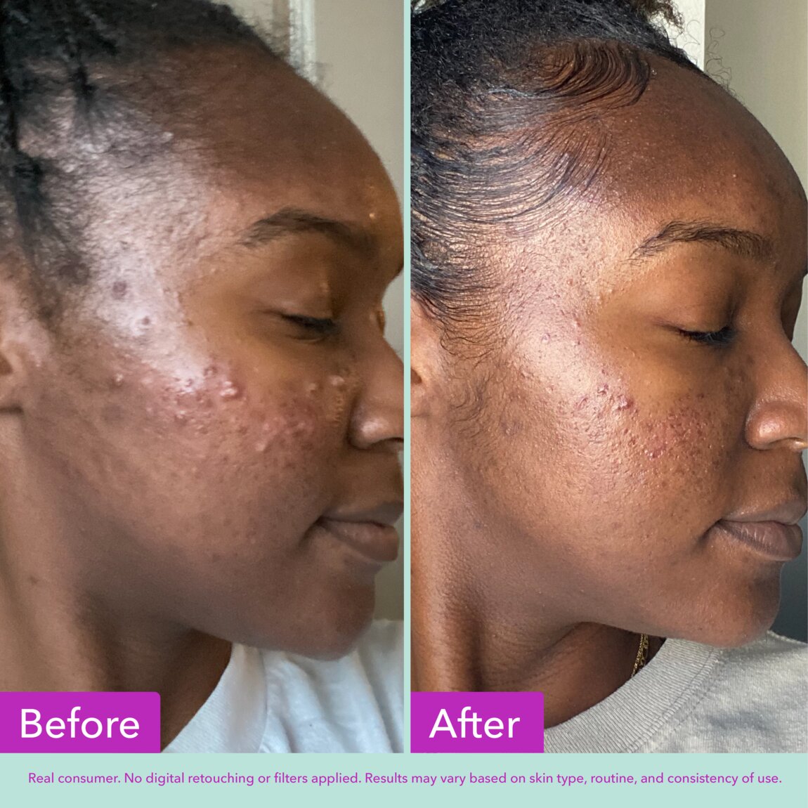acne-foaming-cleanser-u4 zb_p.jpg